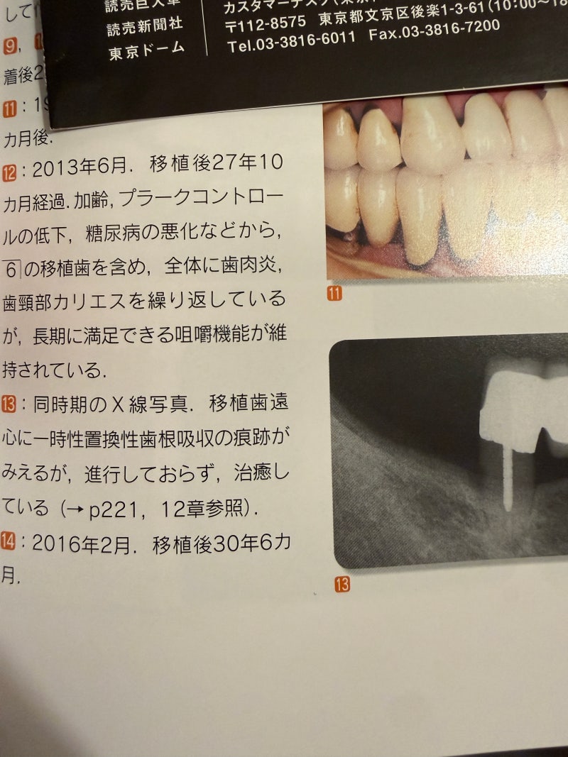 3 Key Success Factors for Long-Lasting Tooth Replantation | Intentional Replantation | Dr. Yong-Hoon Choi 사진 3